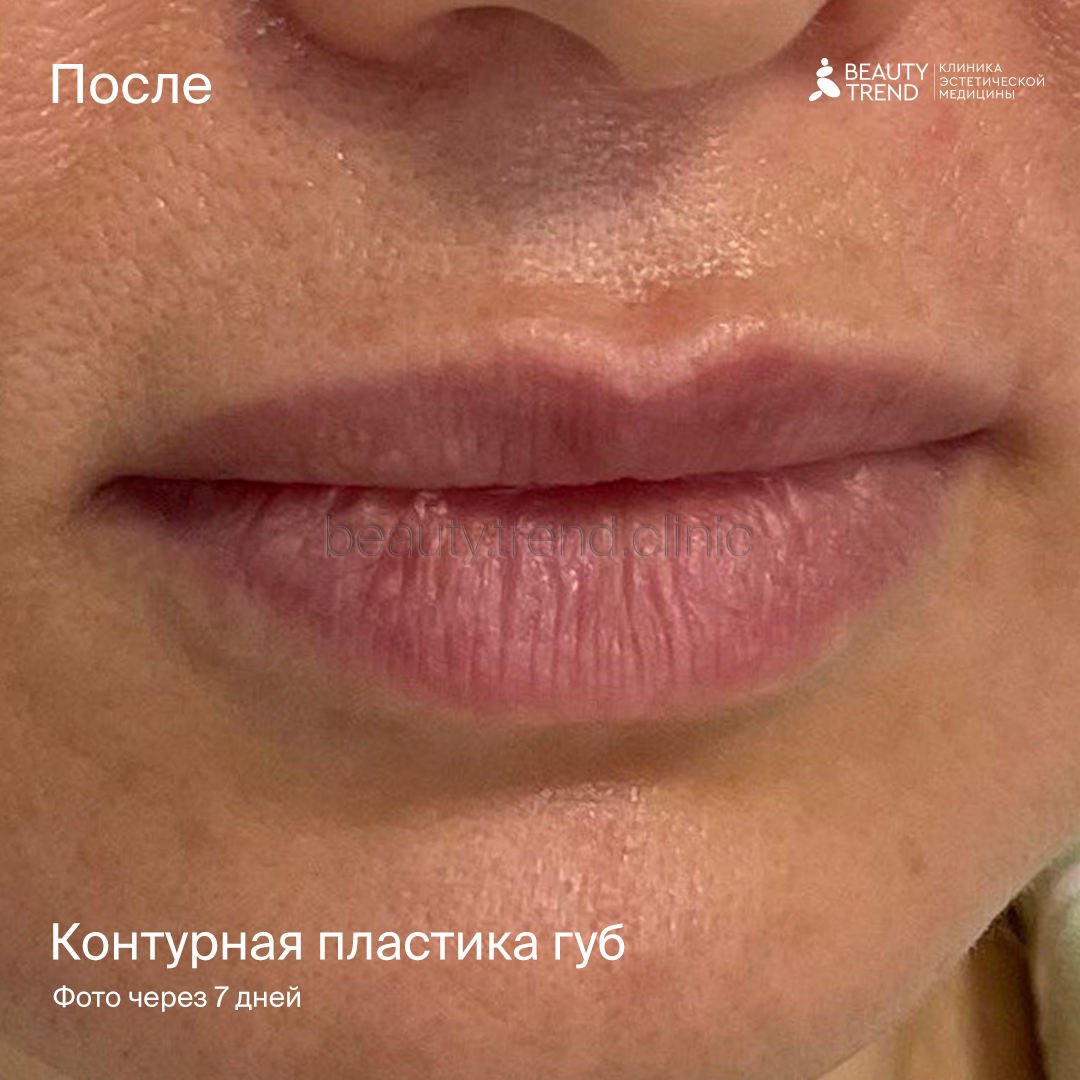 Контурная пластика губ - после 1